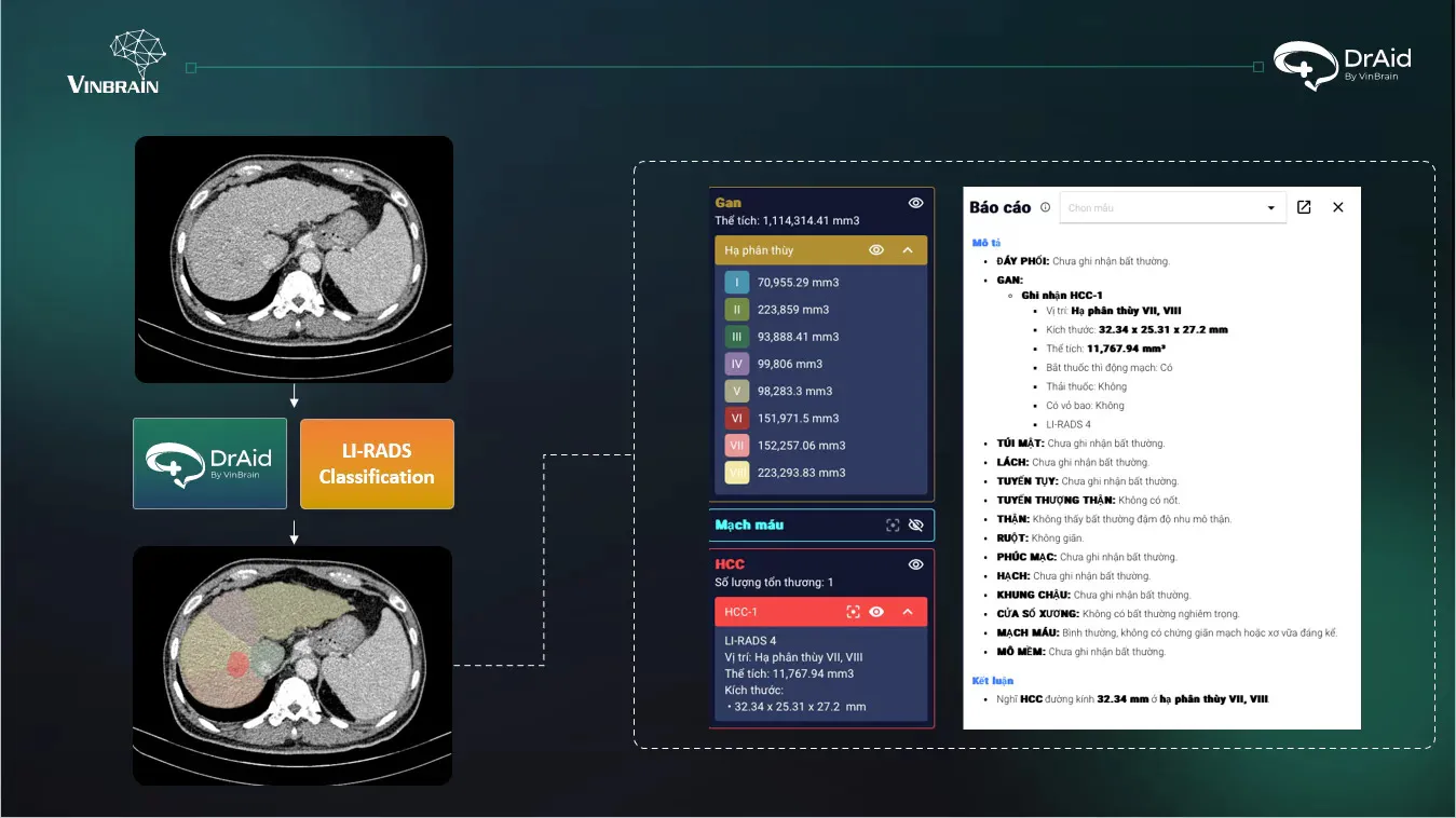 VinBrain ra mắt tính năng đột phá: Phân loại LI-RADS ung thư gan bằng AI, hỗ trợ bác sĩ chẩn đoán chính xác